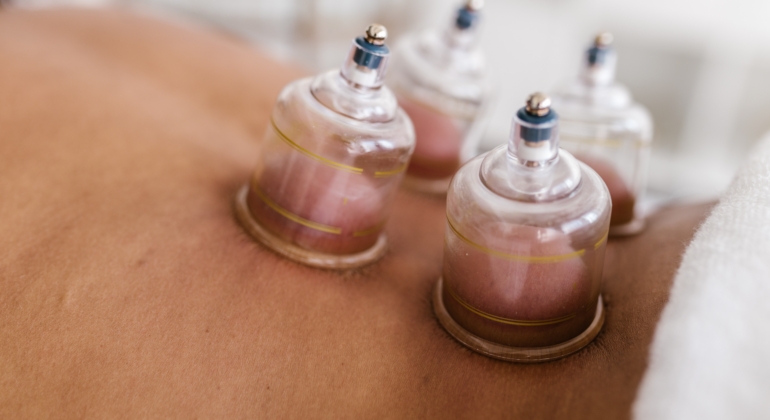 Moxibustion/Cupping