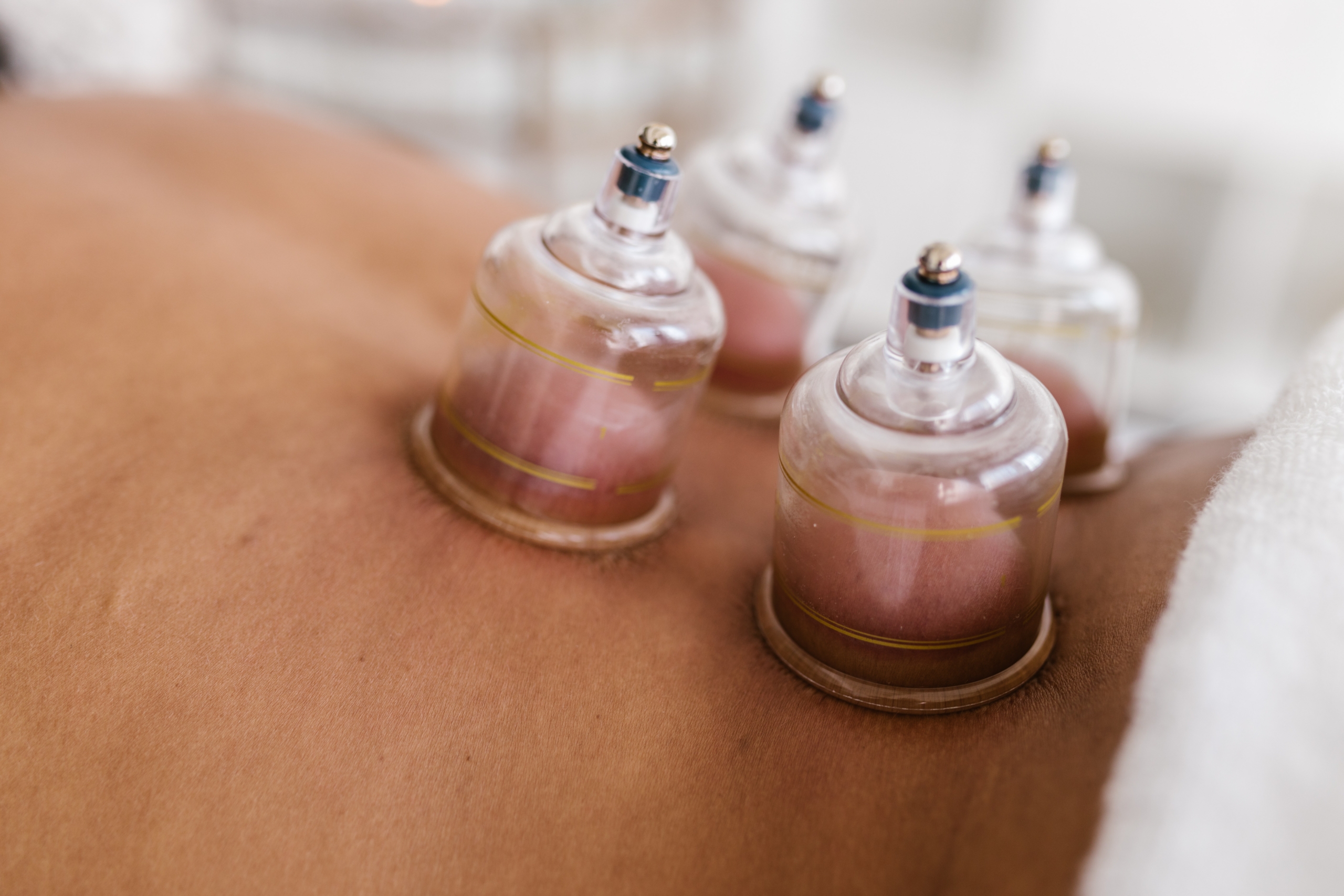 Moxibustion/Cupping